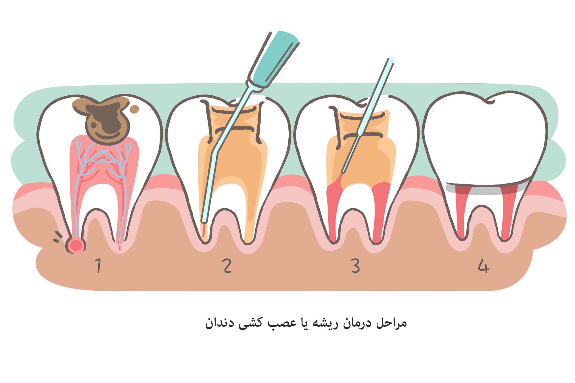مراحل عصب کشی دندان
