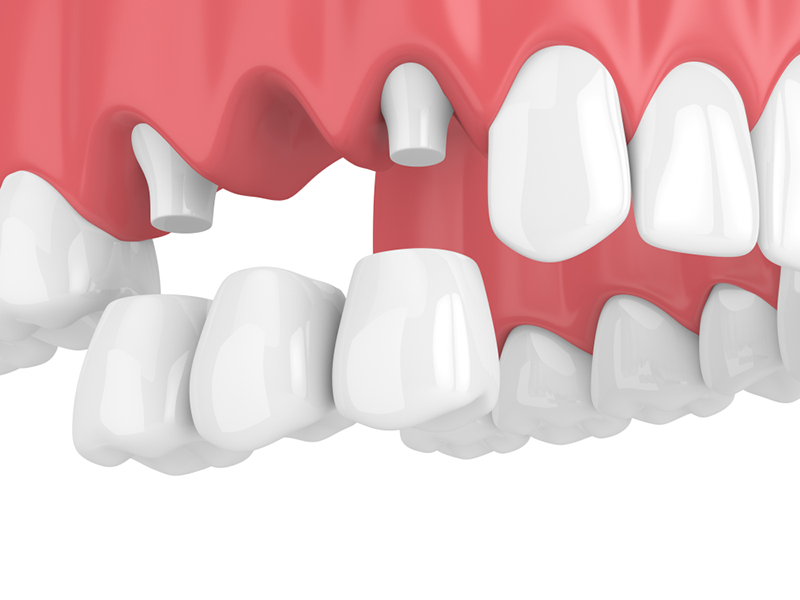 پل دندان - بریج - تاج دندن