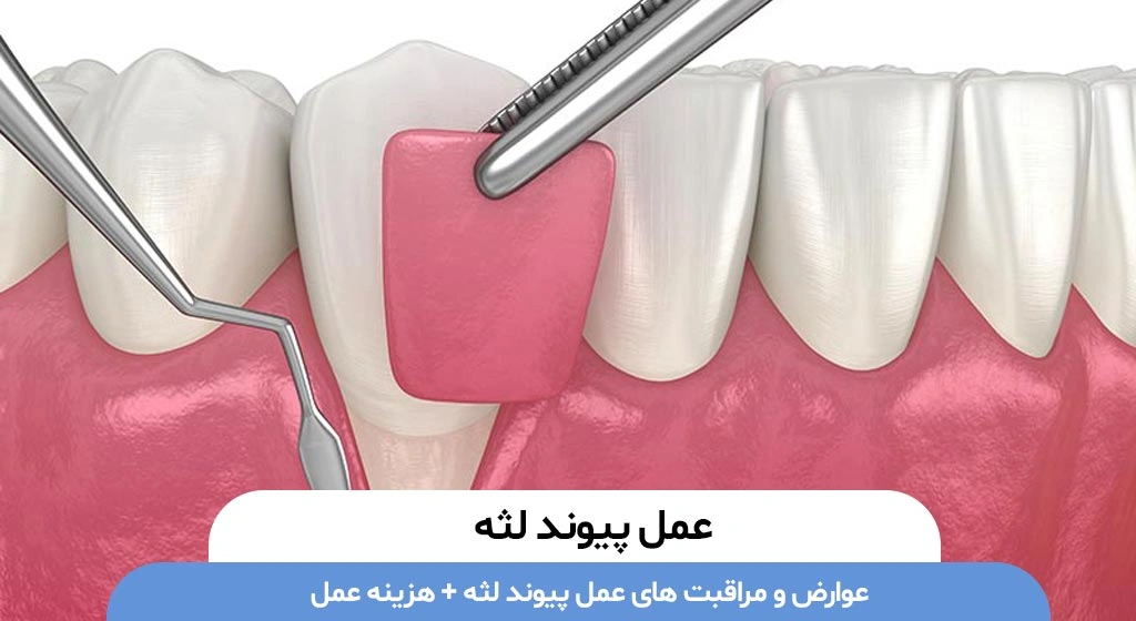 عمل پیوند لثه