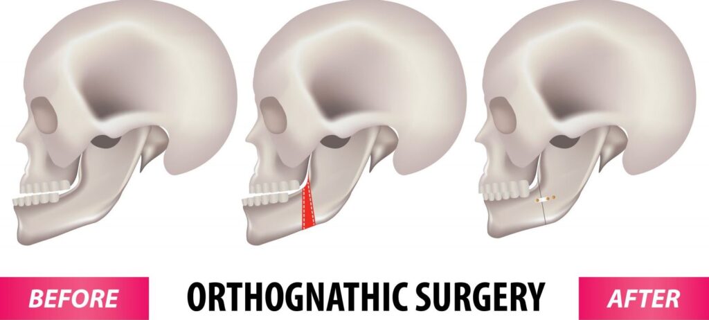 جراحی ارتوگناتیک