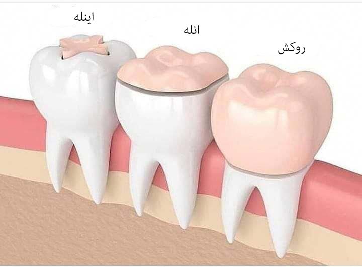 اینله و انله