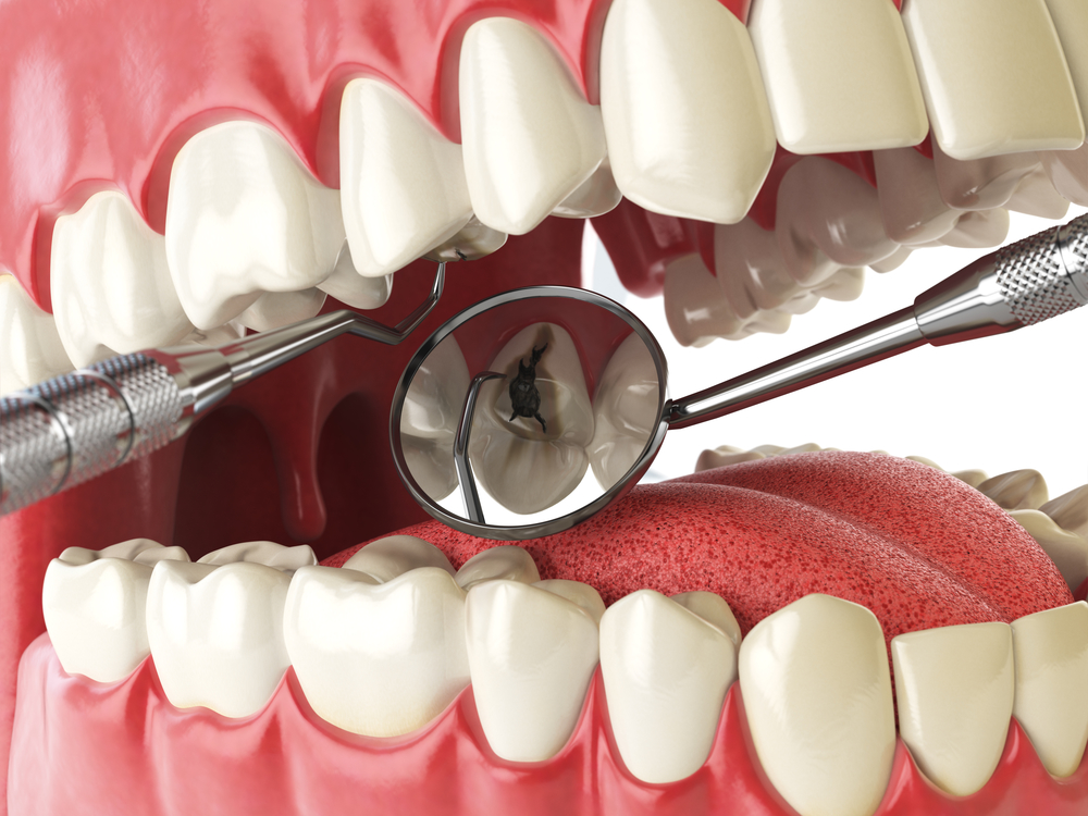 علل عفونت دندان