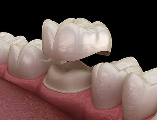 این تصویر دارای صفت خالی alt است؛ نام پروندهٔ آن dental-crown-service-1.jpg است