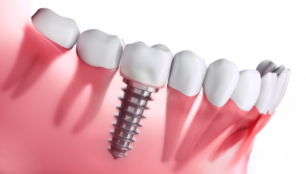 جدول هزینه ایمپلنت دندان