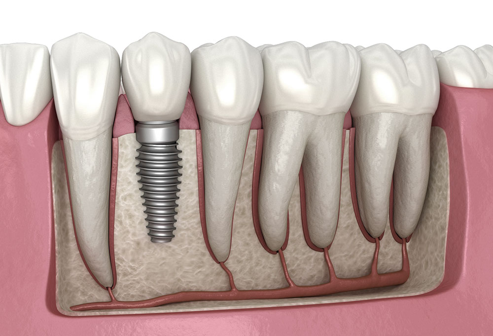 بررسی هزینه ایمپلنت دندان در سال 1400
