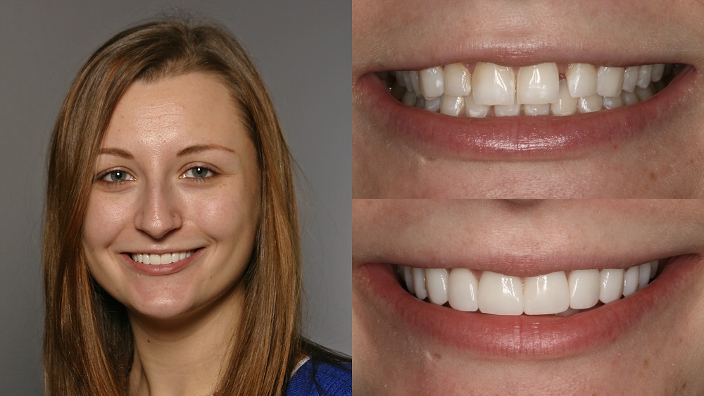 تصویر قبل و بعد از درمان ونیر کامپوزیت دندان