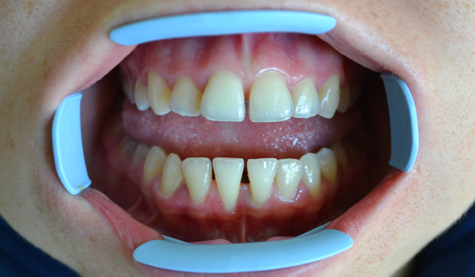 عکس فاصله بین دندان ها