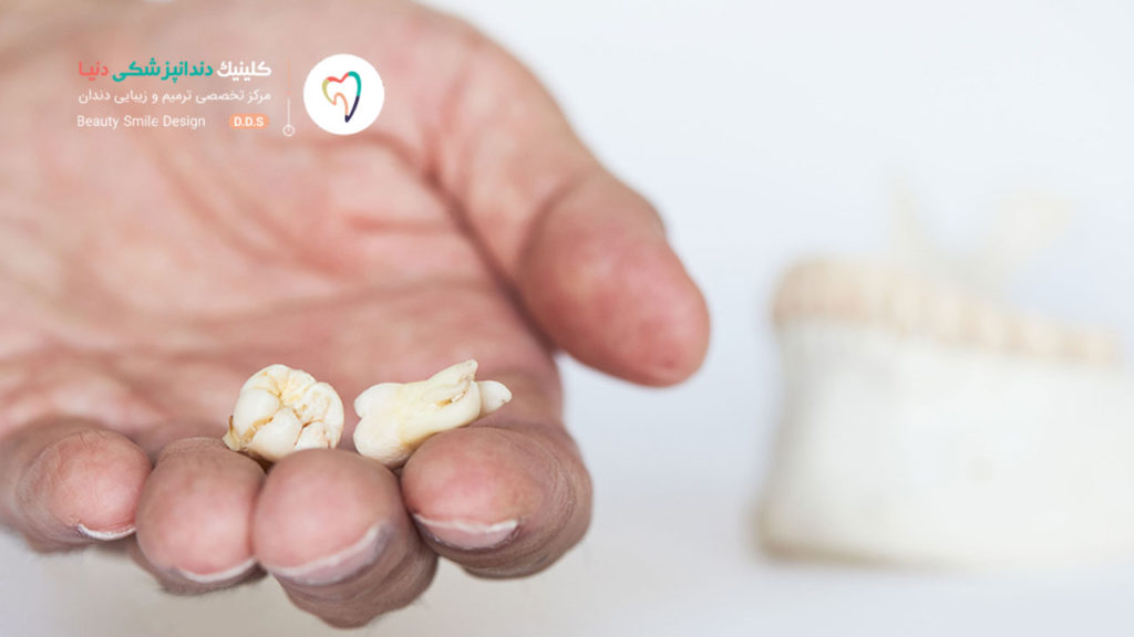 دو عدد دندان عقل کشیده شده که در کف یک دست هستند