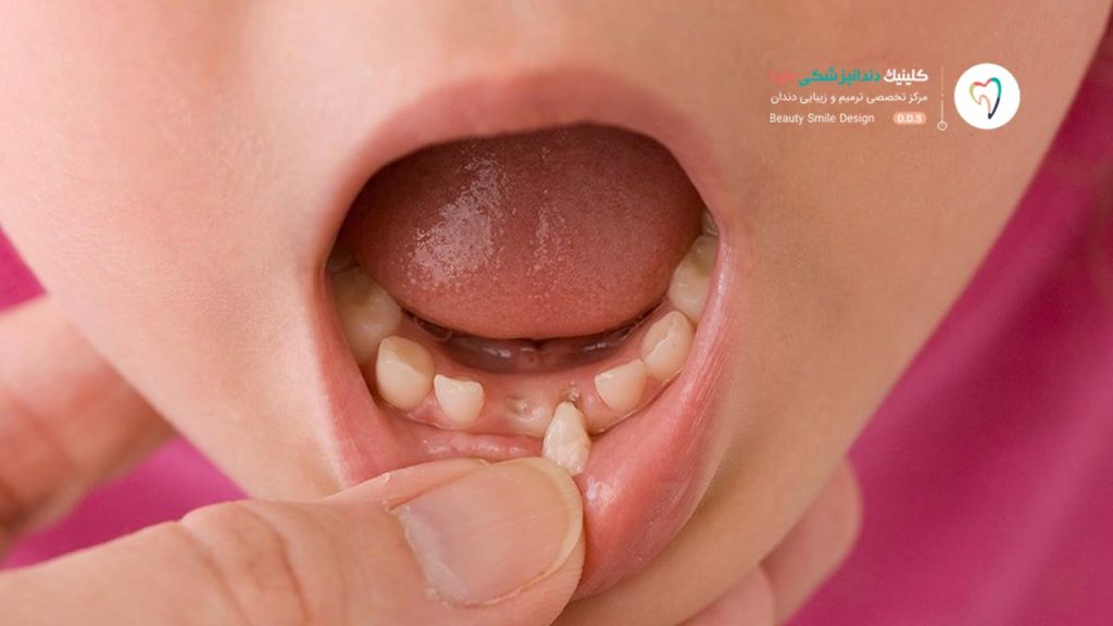 یک کودک که دندان پیششش لق شده و در حال افتادن است