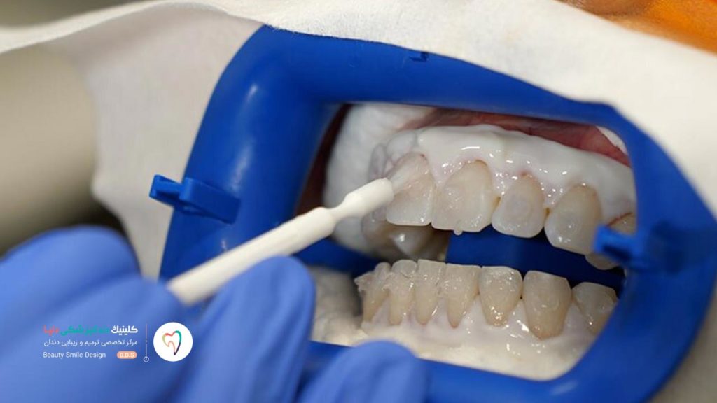 تصویری که نشان می دهد دندانپزشک در حال اتصال مواد سفید کننده به سطح دندان ها است. این اولین مرحله فرآیند بلیچینگ دندان است