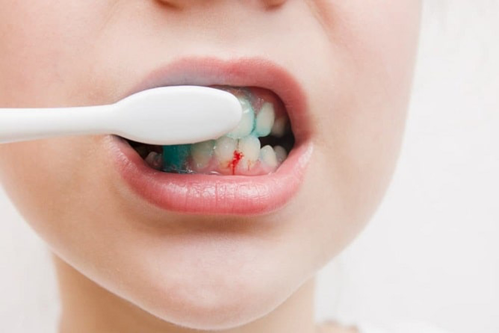 خونریزی اطراف ایمپلنت دندان