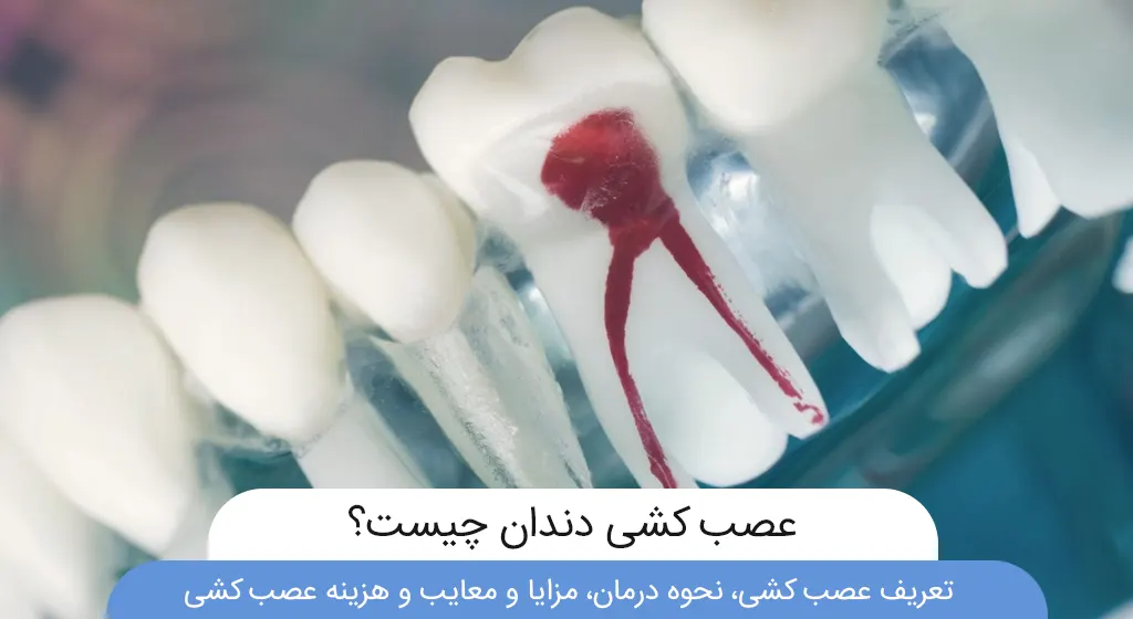 عکس عصب کشی دندان