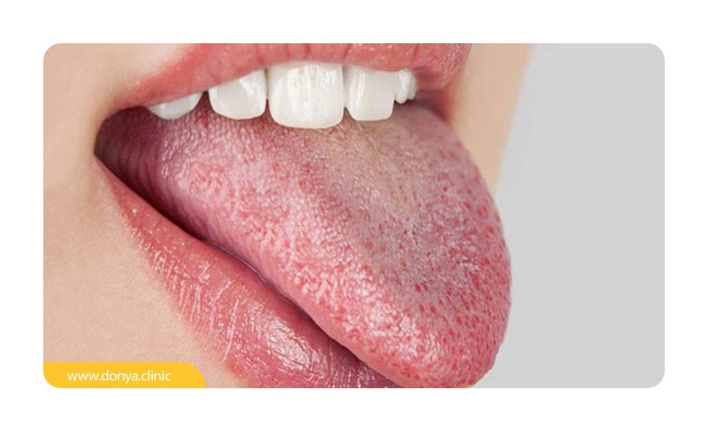 خشکی دهان و علائم آن در زبان