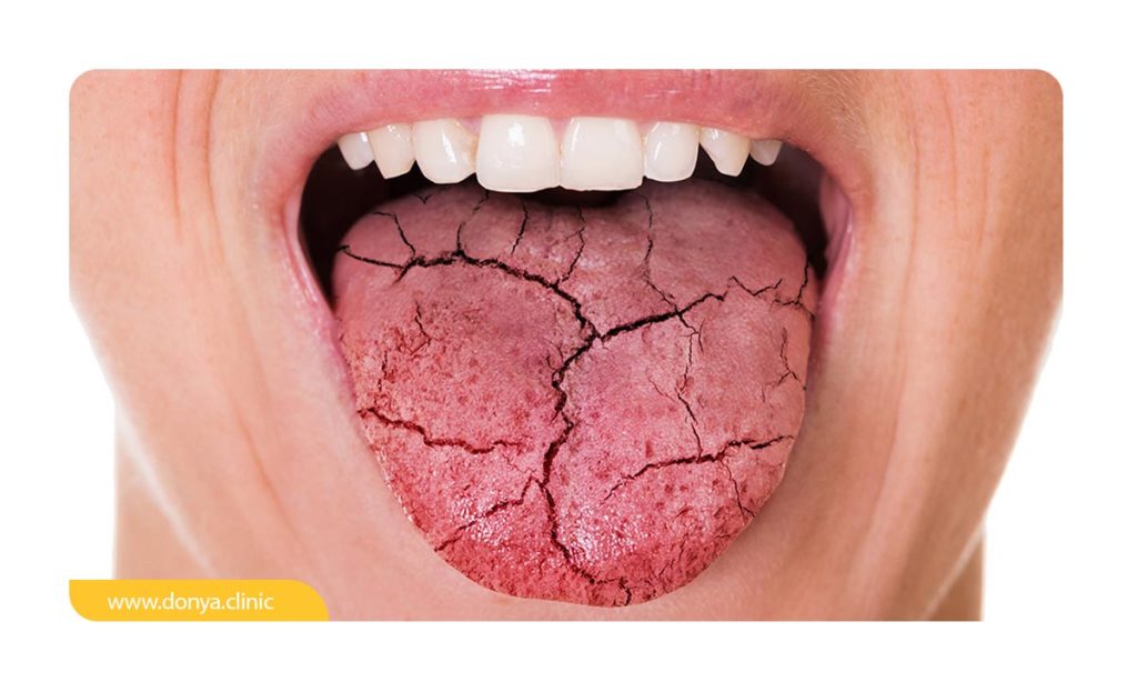 عکس خانمی که دهانش دچار سندروم سوختگی و خشکی زبان است