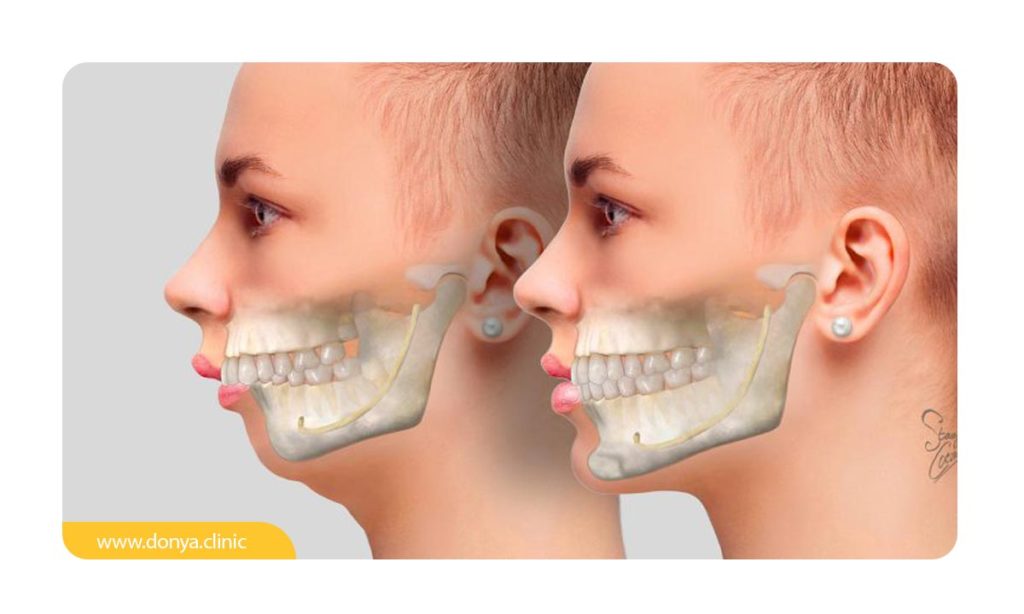 تصویر شماتیک استخوان های فک بالا و پایین در حالت طبیعی و حالت جلوزدگی فک بالا