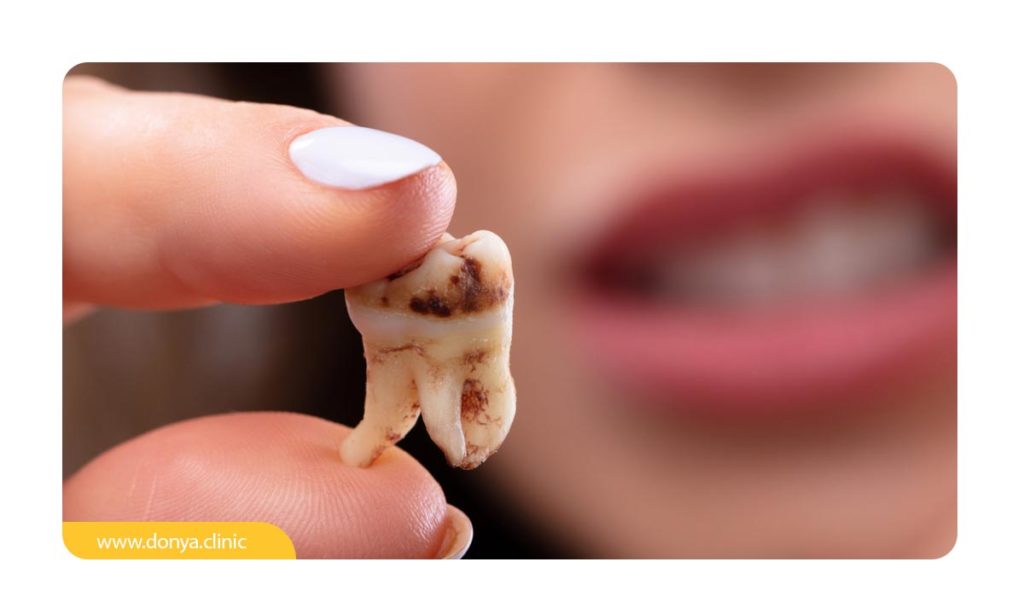 تصویر یک دندان پوسیده بین انگشتان فرد