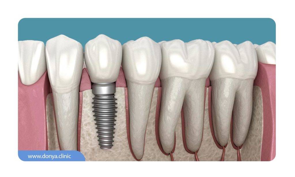 عکس ایمپلنت دندان در میان سایر دندان های دیگر