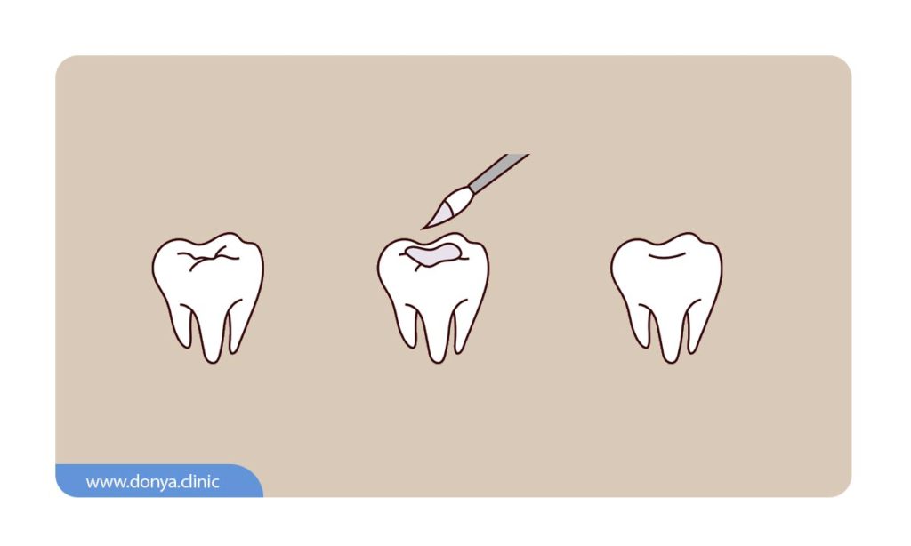 تصویر شماتیک قبل و بعد از فیشور سیلانت دندان