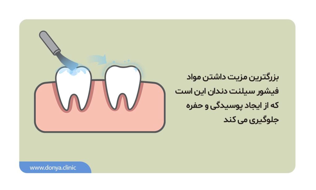 اینفوگرافی مزایای فیشور سیلانت دندان