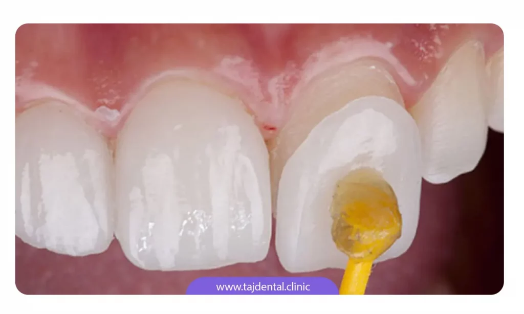 عکسی که نشان می دهد چگونه لمینت دندان روی دندان تراش خورده نصب می شود