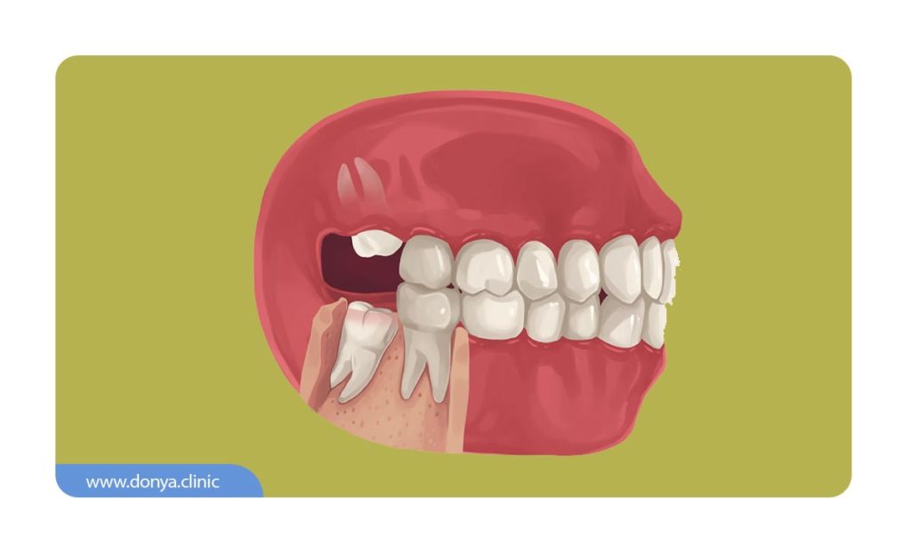 عکس موقعیت دندان عقل نهفته