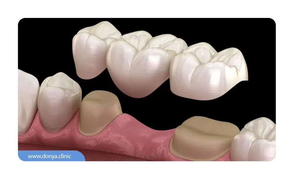 تصویر یک بریج دندان سنتی