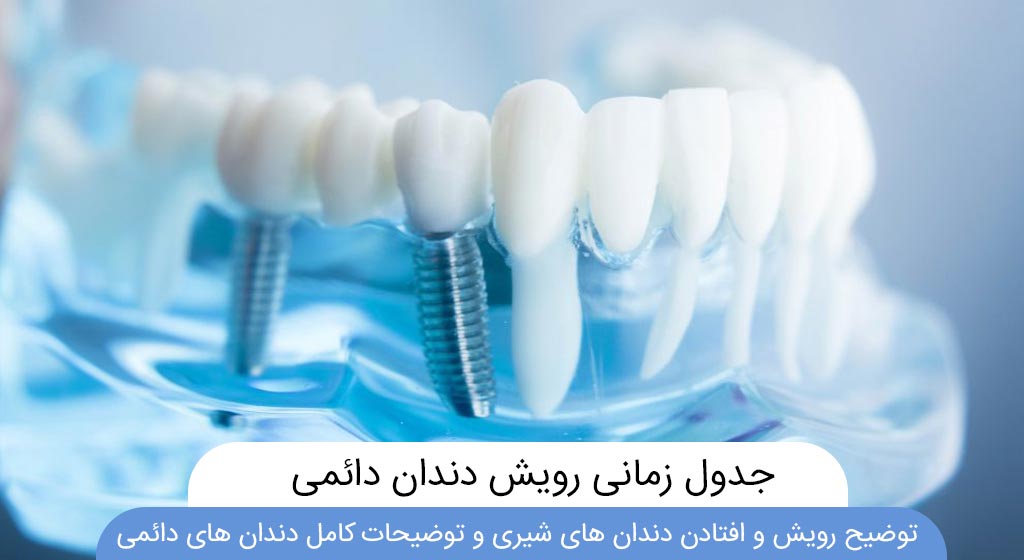 شاخص هزینه و قیمت ایمپلنت دندان