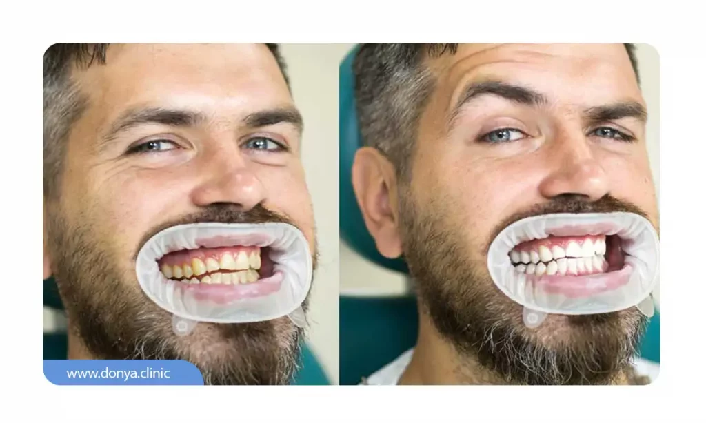 قبل و بعد از بلیچینگ دندان