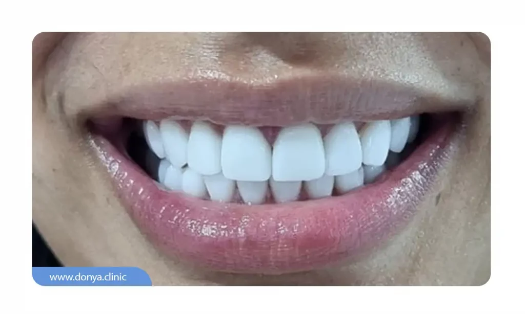 قبل و بعد از اصلاح طرح لبخند با ونیر کامپوزیت دندان