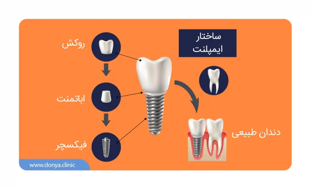 عکس بخش های مختلف ایمپلنت دندان