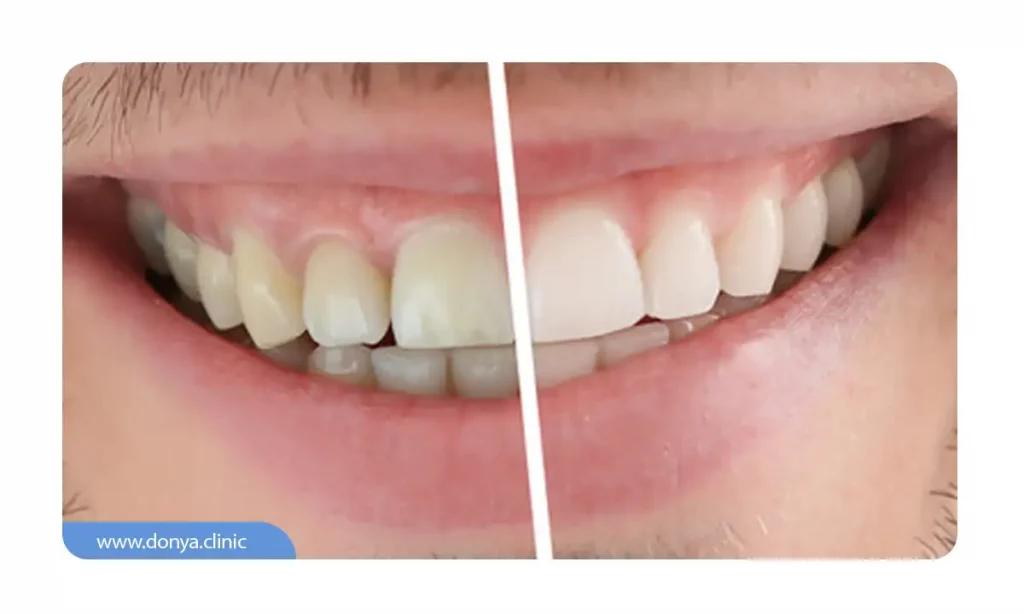 قبل و بعد از اصلاح طرح لبخند (با بلیچینگ)