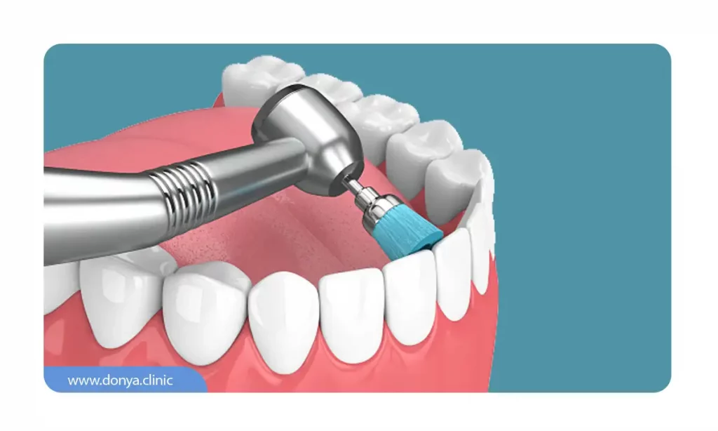 پالیش دندان بعد از جرمگیری
