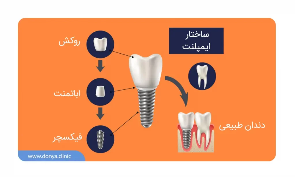 عکس شماتیک اجزای مختلف ایمپلنت دندان