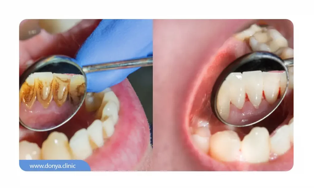 عکس قبل و بعد جرمگیری دندان
