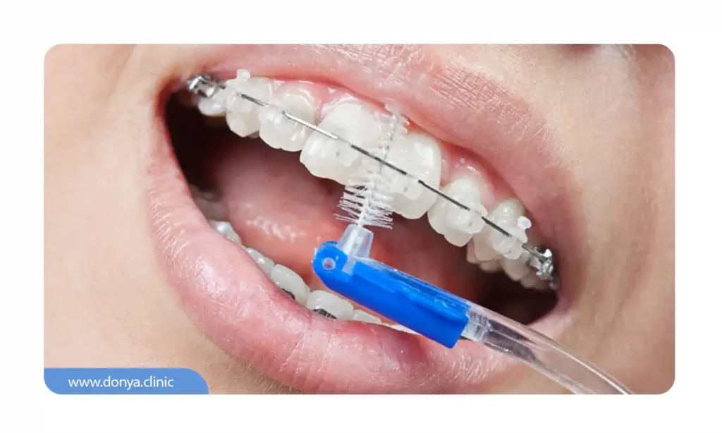 نحوه استفاده از مسواک بین دندانی در ارتودنسی ثابت
