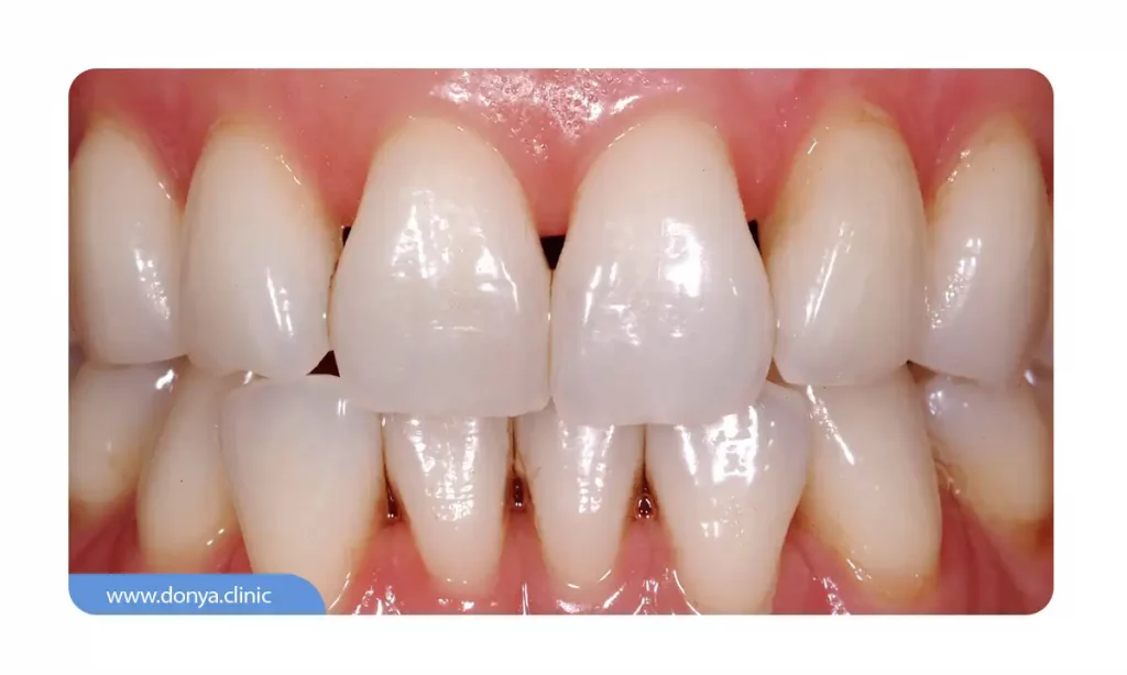 عکس فاصله بین دندان ها