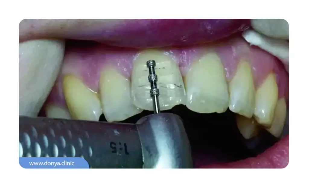 میزان تراشیدن مینای دندان برای لمینت