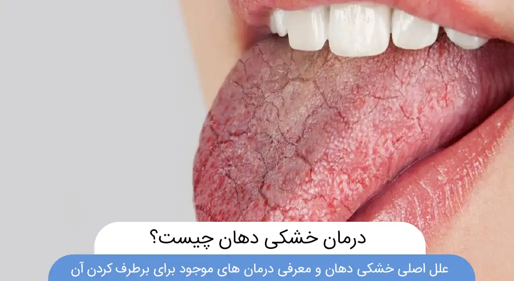 علت و درمان خشی دهان
