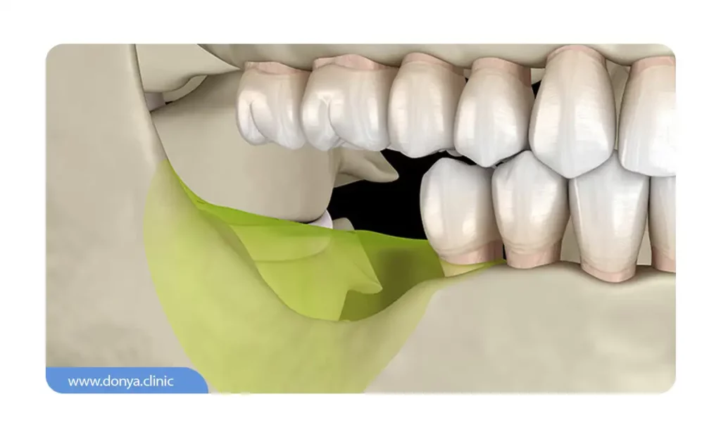 جای خالی دندان کشیده شده و تحلیل استخوان قبل از کاشت ایمپلنت