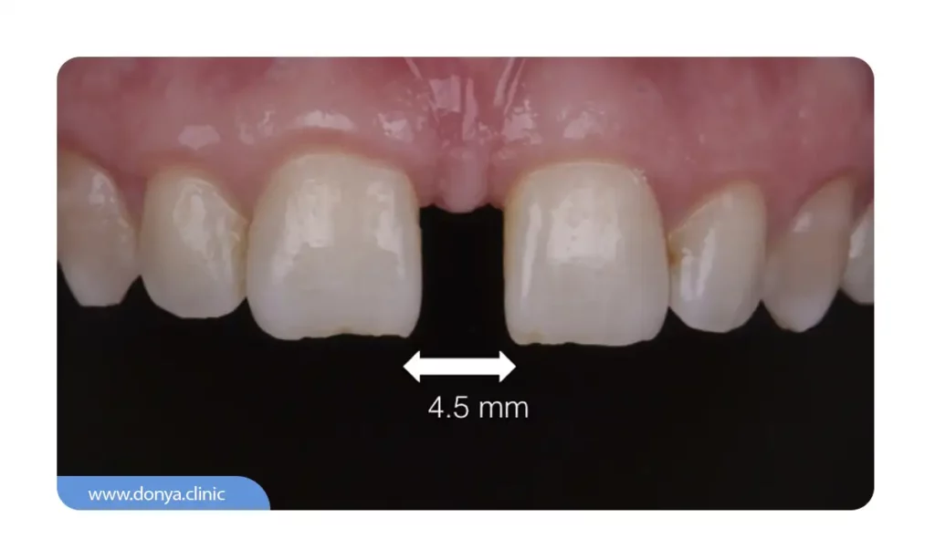 عکس فاصله بین دندان ها به اندازه 4.5 میلی متر