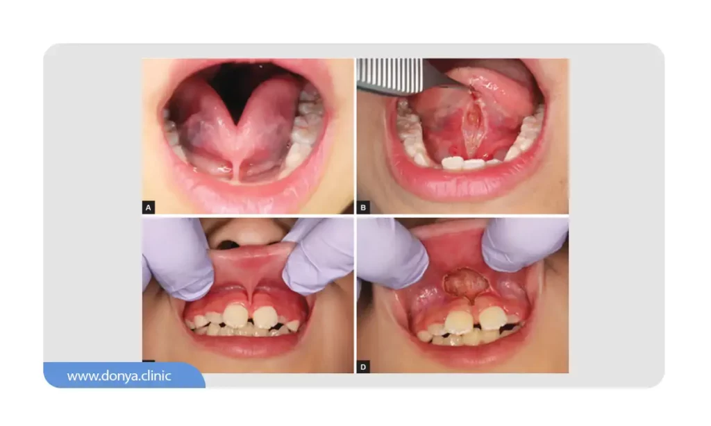 برداشتن فاصله بین دندان ها با فرنکتومی