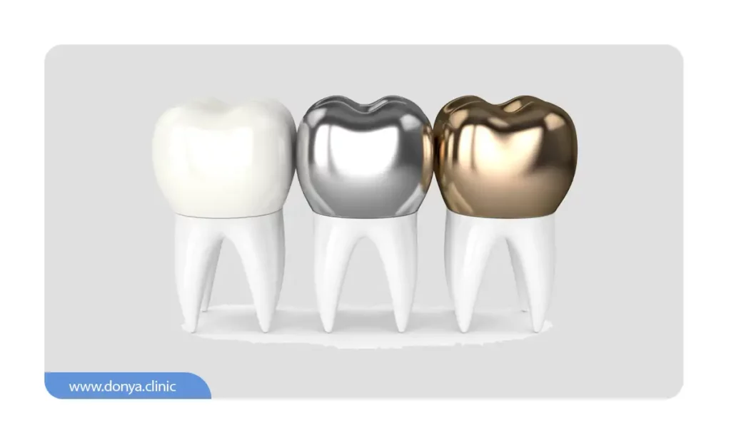 عکس شماتیک انواع روکش دندان
