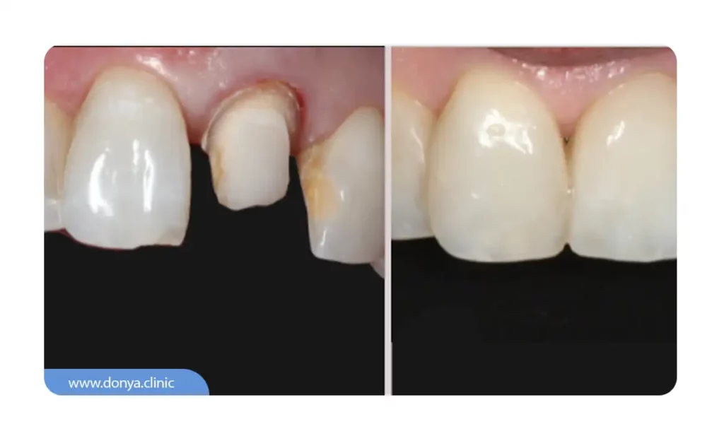 عکس قبل و بعد از روکش دندان