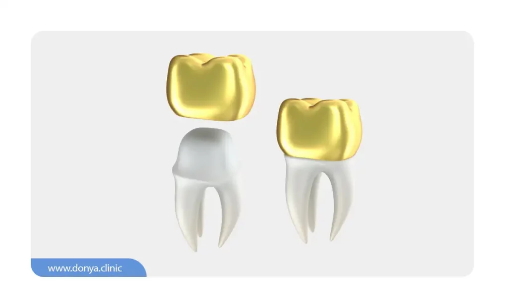 عکس شماتیک روکش دندان طلا