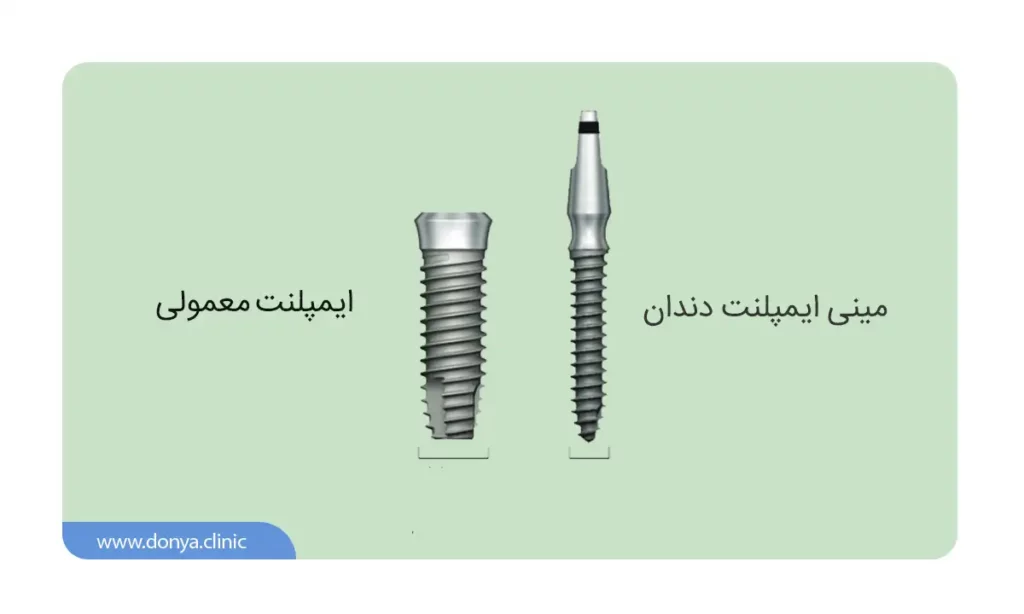 اینفوگرافی مینی ایمپلنت دندان