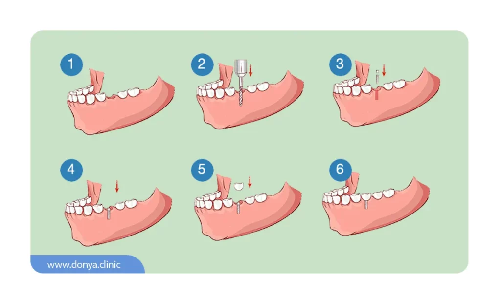 اینفوگرافی مراحل مینی ایمپلنت دندان