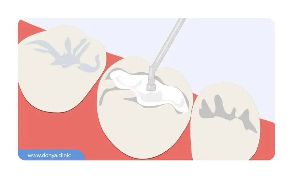 عکس شماتیک پر کردن دندان با مواد سفید