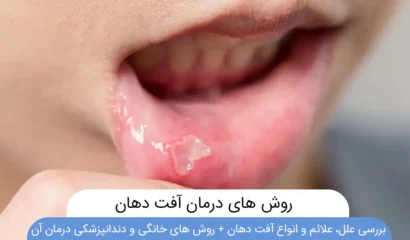 درمان سریع آفت دهان