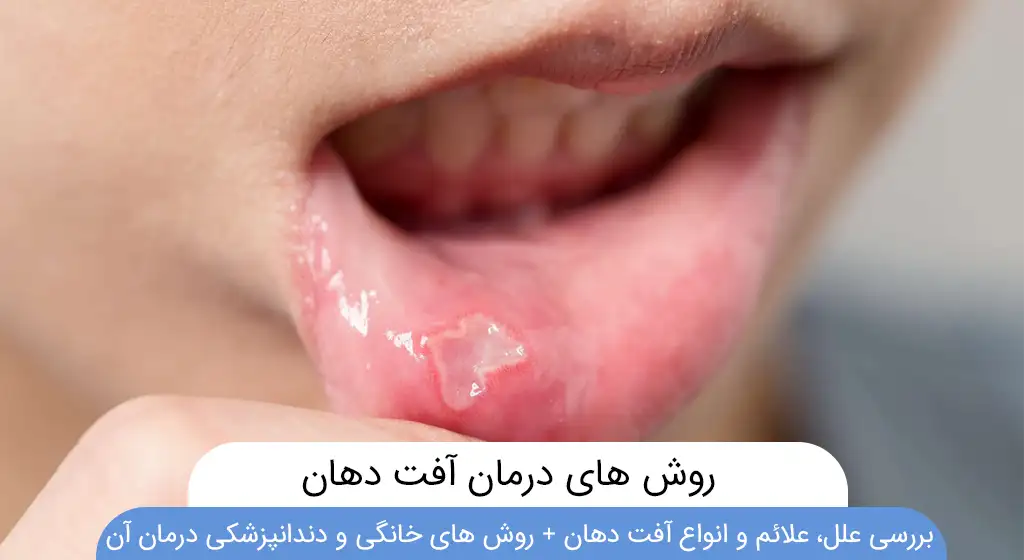 درمان سریع آفت دهان