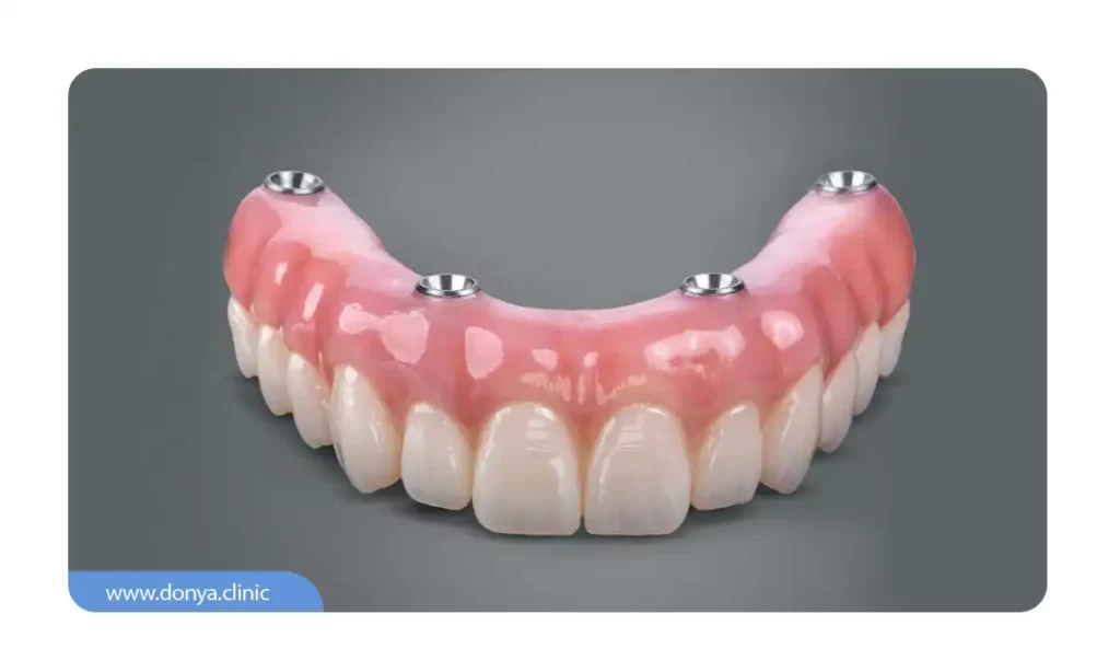 عکس اوردنچر یا دندان مصنوعی ثابت